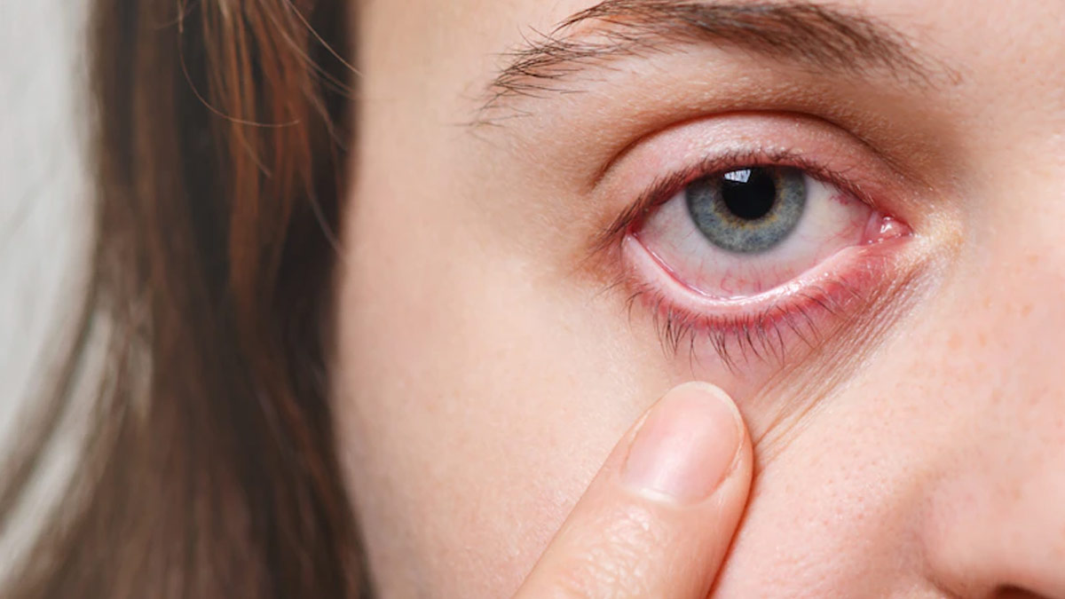 Dry Eyes Due To Smog? Ways To Remedy This At Home