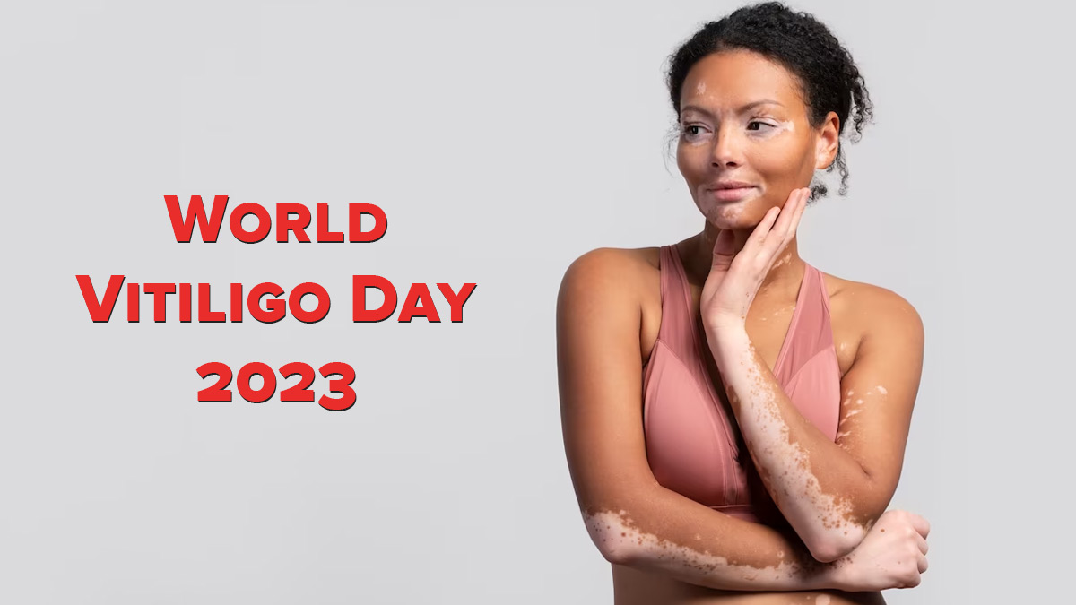 World Vitiligo Day 2023: Significance And Why It's Celebrated