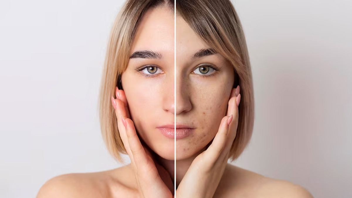 6 Easy Tips To Lighten Facial Scars