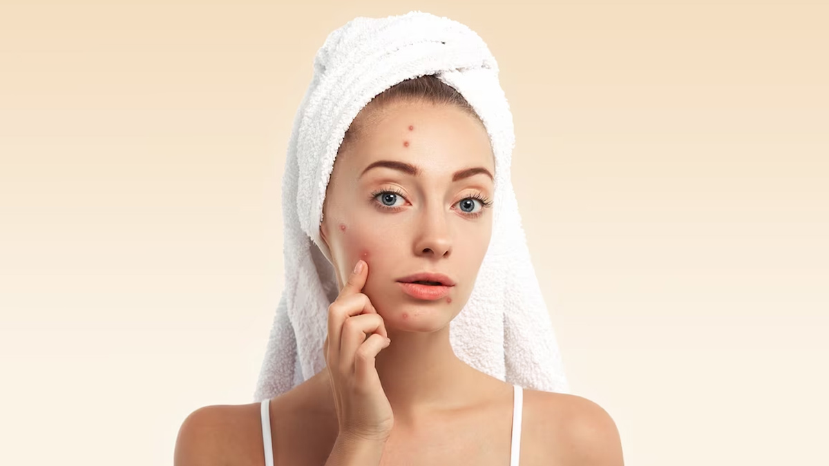 Ultimate Guide For Clearing Summer Acne Naturally