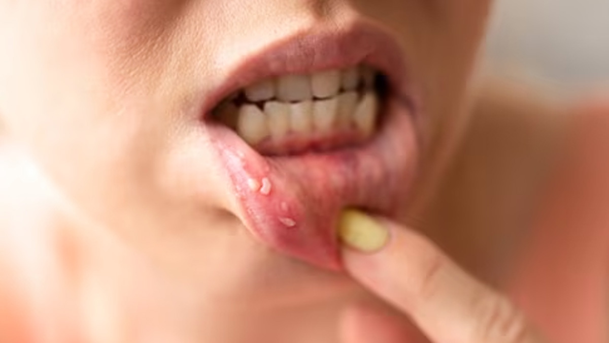 Causes And Prevention Of Mouth Cancer, Expert Weighs In