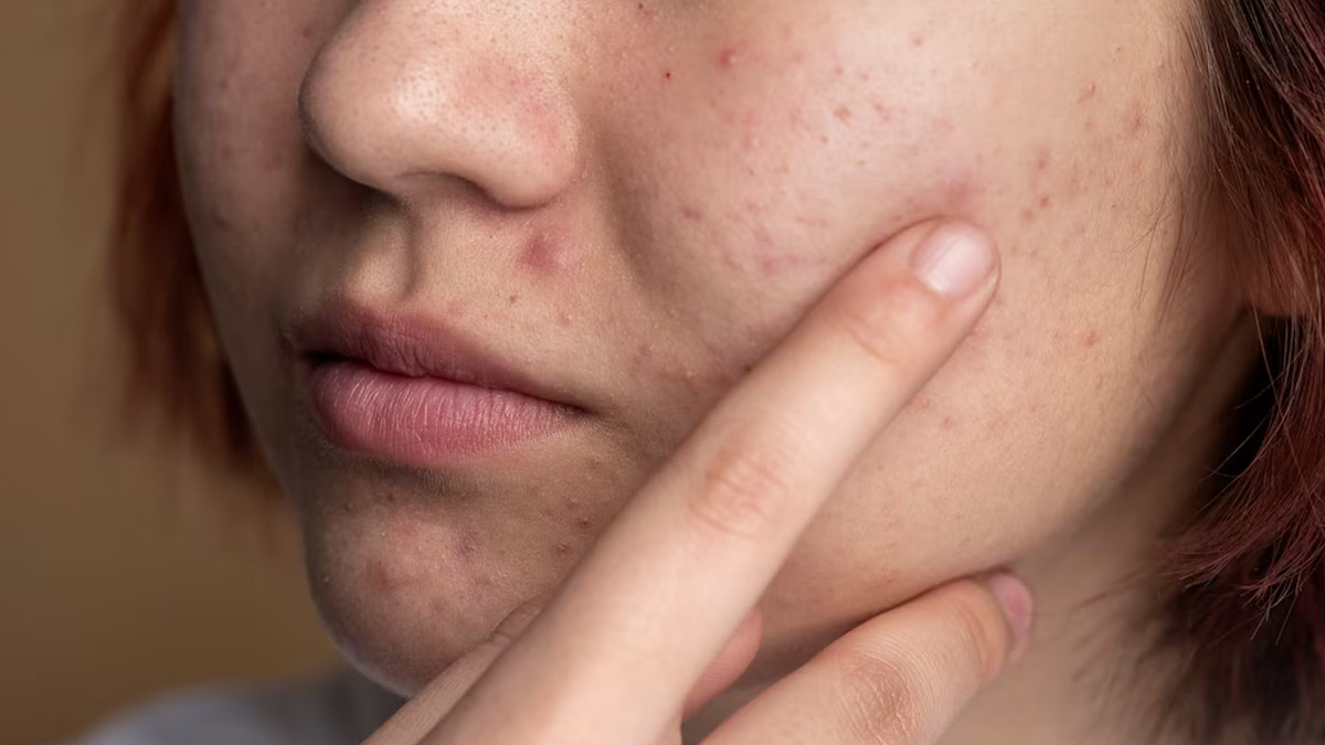 Understanding Acne Purging: Causes and Effective Treatment Strategies