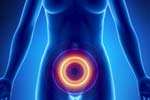 What is the Diagnosis of Interstitial Cystitis?