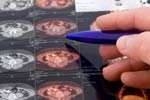What is the diagnosis of Colorectal Cancer?