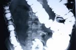 Why is Barium Enema done?