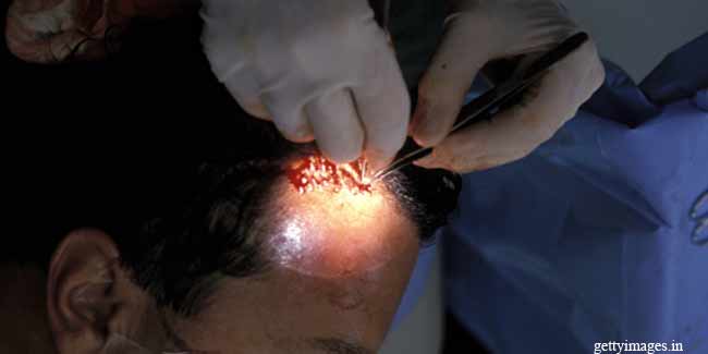 Is it Safe to Undergo Hair Transplantation?
