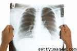What is Emphysema?