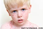 What is the Treatment of Rocky Mountain spotted fever?