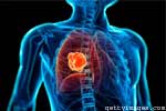 What is the diagnosis of Emphysema?