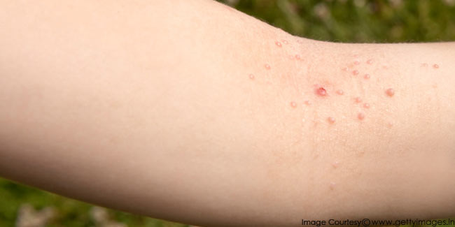 How to Treat Molluscum Contagiosum in Children