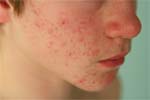 What is Contact Dermatitis?