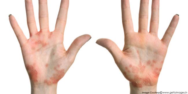 What Causes Scalded Skin Syndrome Onlymyhealth