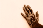 Facts that will Dispel Myths about Vitiligo