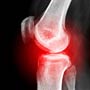What is a Leg Fracture?