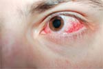 How to Know if you have Cataracts
