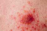 What is Lyme Disease?