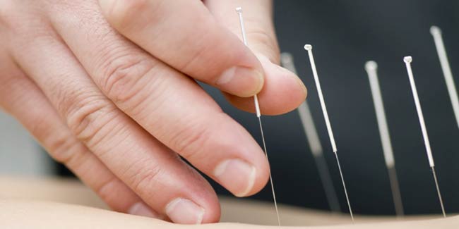 Learn About The Different Types of Acupuncture Needles