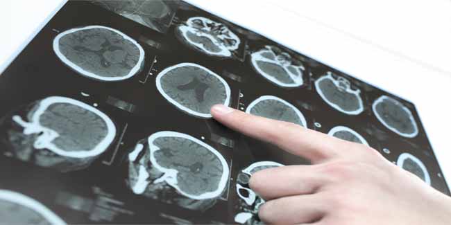 ब्रेन ट्रॉमा के इलाज में देरी से हो सकता है नुकसान