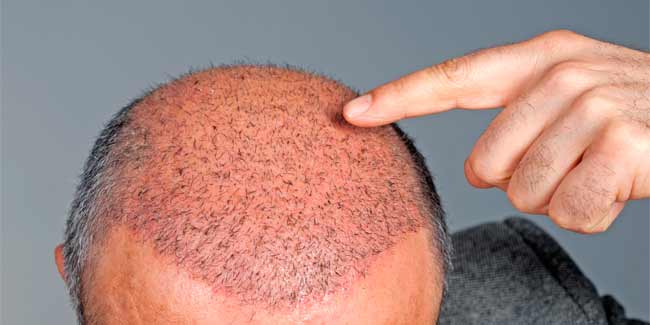 Tips To Reduce Swelling After Hair Transplant Onlymyhealth