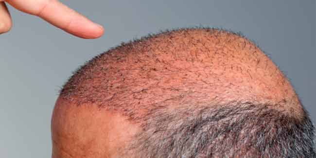 गंजेपन की समस्‍या से निजात पाने का सबसे अच्‍छा तरीका है बालों की सर्जरी 