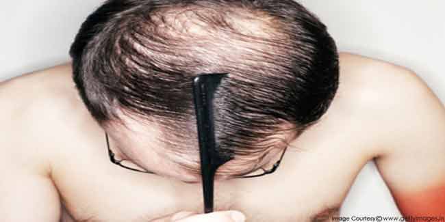 Causes of Hair Loss in Men | Fashion & Beauty