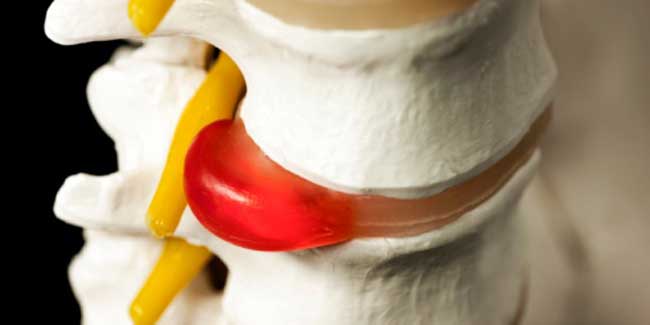 What are the Symptoms of Pinched Nerves?