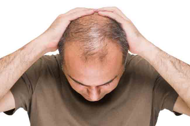 alopecia universalis treatment 2013 alopecia universalis treatment 2013
