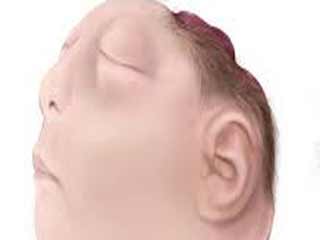 Anencephaly – Symptoms, Causes, Treatment, Preventions, Diagnosis