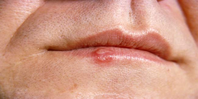 Cold Sores and Fever Blisters: When should one seek medical advice?