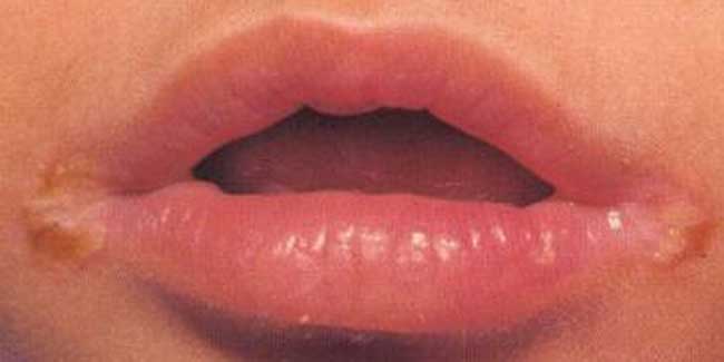 Cheilosis: When Should one Seek Medical Advice?