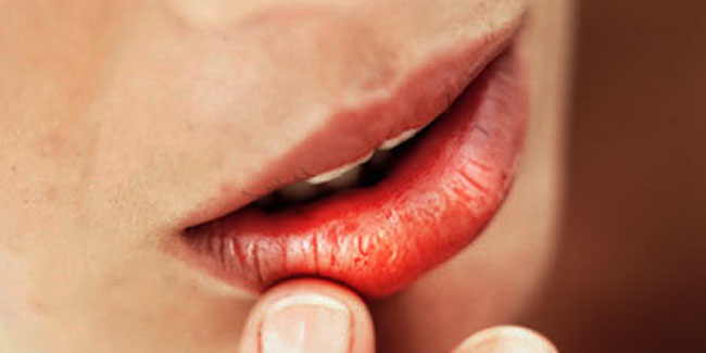 What are the symptoms of Cheilosis?