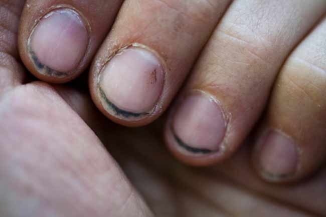 damages-chronic-nail-biting-can-cause