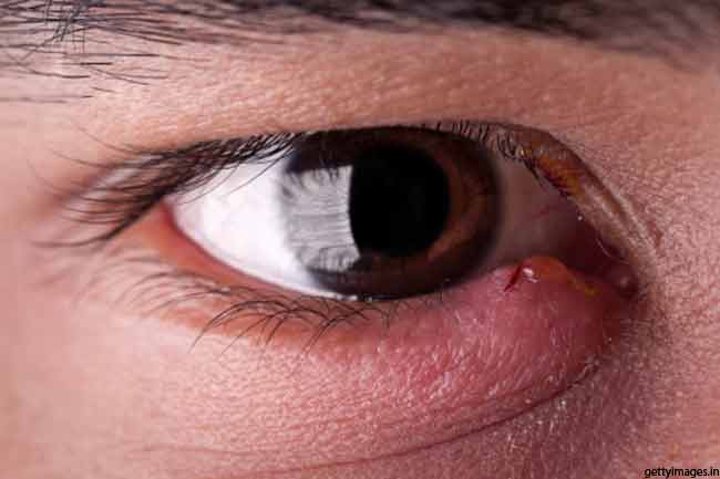 Image result for आंखों की सूजन
