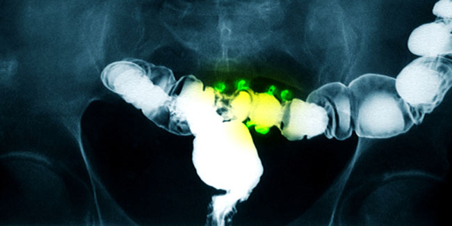 Points to remember about Virtual Colonoscopys