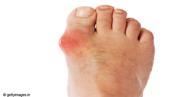 How To Treat Big Toe Arthritis