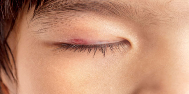 5 Home Remedies for an Eye Stye
