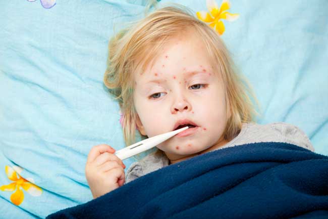 Natural Remedies To Treat Measles 