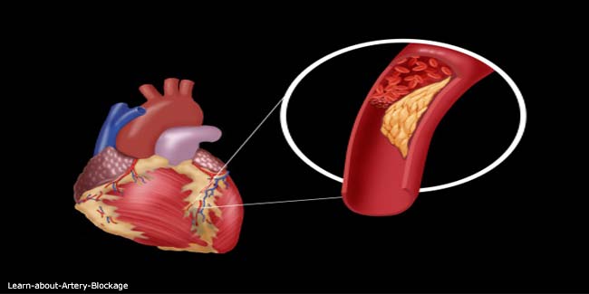 what-is-heart-arteries-blockage-youtube