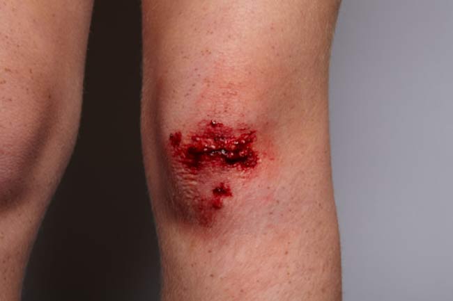 Image result for चोट का घाव