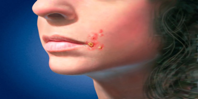 How can one prevent Impetigo?
