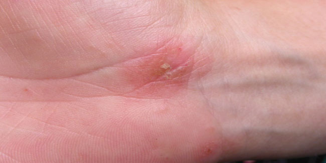 How common is Epidermolysis Bullosa?