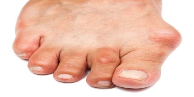 Effective home remedies for treating gout
