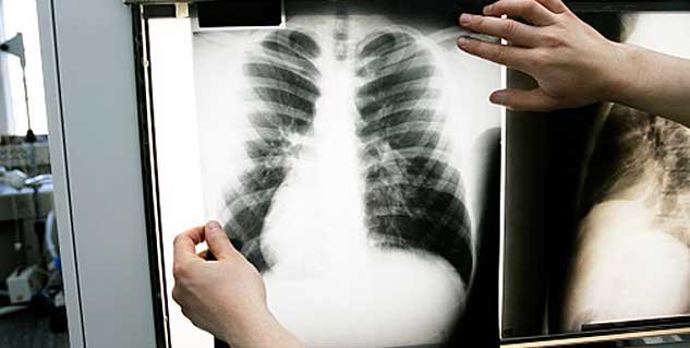 Risk factors for ARDS