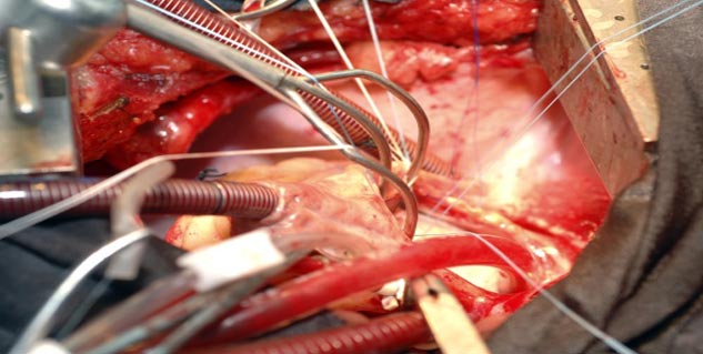 Hear volve Surgery in hindi