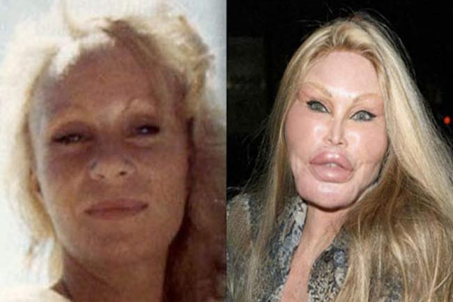 Want a horror story? Here are 5 plastic surgeries that went horribly wrong