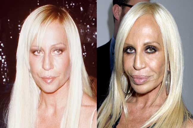 Want a horror story? Here are 5 plastic surgeries that went horribly wrong