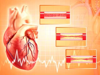 एंजियोप्लास्टी सर्जरी के बारे में विस्तार से जानें 