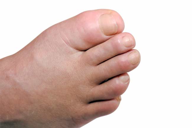 7-tips-to-treat-swollen-feet-in-diabetics