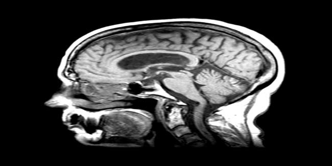 Childhood atypical teratoid: What to expect?