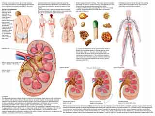 किडनी की पथरी के लिए शॉक वेव लीथोट्रिप्सी ट्रीटमेंट